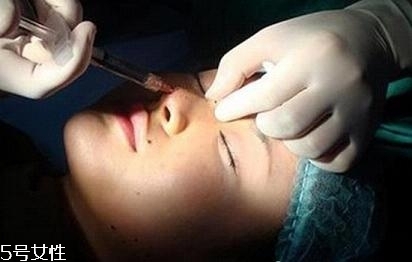 玻尿酸隆鼻多久能洗臉？玻尿酸隆鼻會(huì)越來(lái)越寬