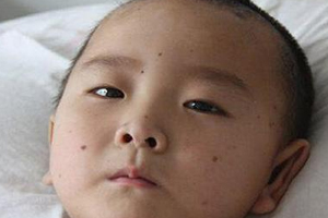 痣什么情況下會(huì)轉(zhuǎn)變?yōu)榱?？點(diǎn)痣不可取