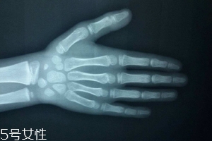 哪些人需要測(cè)骨齡？長(zhǎng)太快警惕骨齡提前