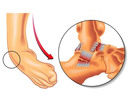 崴腳了怎么辦？緩解疼痛6大招