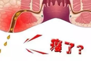 肛瘺非手術(shù)治療才可以嗎？手術(shù)是治療的關(guān)鍵途徑