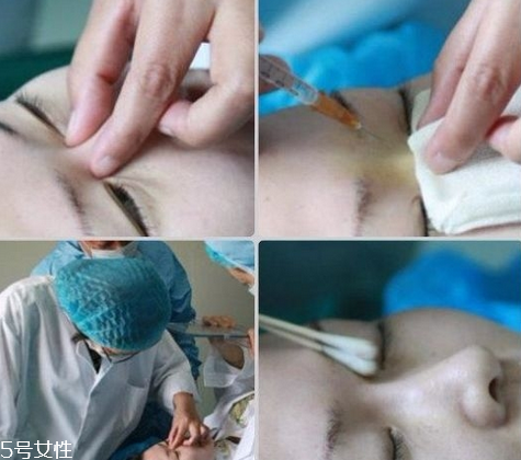 玻尿酸隆鼻維持時(shí)間受什么影響？玻尿酸不能過度注射