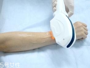 激光脫毛需要幾次？激光脫毛并不是終身有效的