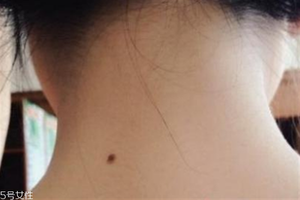 脖子后面有痣好嗎？激光冷凍祛痣易導(dǎo)致癌變