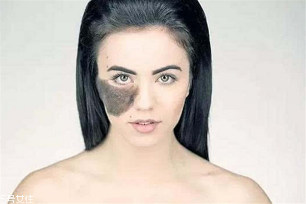 胎記長在哪里有福氣？胎記的本質(zhì)是色素沉著