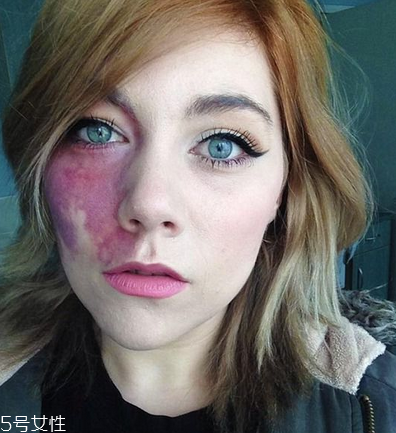 胎記長(zhǎng)在哪里有福氣？胎記的本質(zhì)是色素沉著