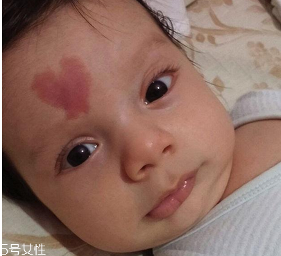 去胎記要多少錢？胎記去除后要做好護(hù)理