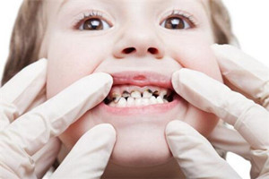 寶寶齲齒常有哪些問(wèn)題？齲齒問(wèn)題需注意