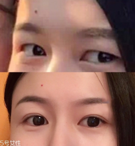 內雙怎么進化成雙眼皮？全是雙眼皮貼的功勞