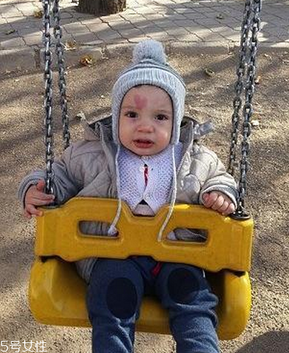 胎記長(zhǎng)在哪里有福氣？胎記的本質(zhì)是色素沉著