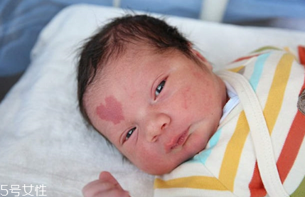 胎記長(zhǎng)在哪里有福氣？胎記的本質(zhì)是色素沉著