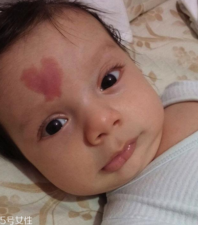 胎記長(zhǎng)在哪里有福氣？胎記的本質(zhì)是色素沉著