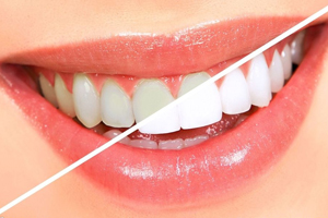 牙齒發(fā)黃是天生的嗎？只是你刷牙偷懶了