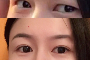 內(nèi)雙怎么進(jìn)化成雙眼皮？全是雙眼皮貼的功勞