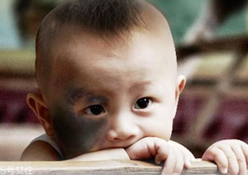 胎記怎么去除？胎記有遺傳的可能