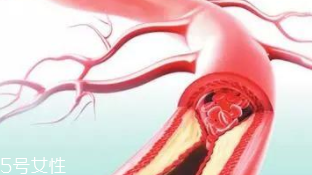 血管堵塞怎么自查？腿腳告訴你答案