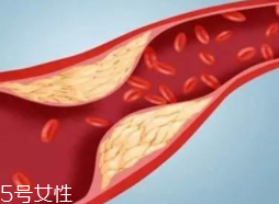 血管堵塞怎么自查？腿腳告訴你答案