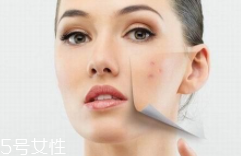 痘印多久能自行消失？多數(shù)人一年內(nèi)消失