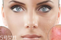 痘印多久能自行消失？多數(shù)人一年內(nèi)消失