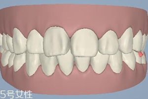 磨牙有哪些癥狀？牙齒變形甚至脫落