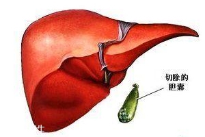 膽囊為什么容易長結(jié)石？與個(gè)體因素密切相關(guān)