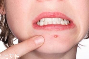 肌膚需要排毒嗎？長(zhǎng)痘并不代表排毒