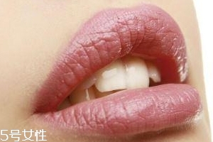 冬天爛嘴角什么原因？有可能營養(yǎng)不良