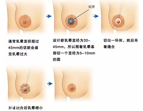 乳暈縮小術(shù)怎么做？乳暈縮小術(shù)知識(shí)全解