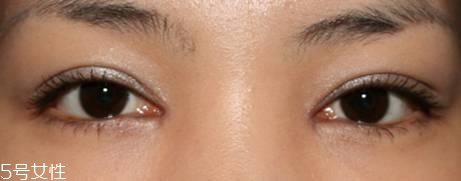 怎么縮短開(kāi)眼角疤痕消失時(shí)間？雙眼皮開(kāi)眼角恢復(fù)過(guò)程