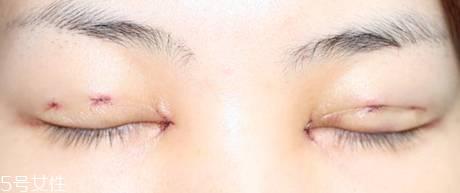 怎么縮短開(kāi)眼角疤痕消失時(shí)間？雙眼皮開(kāi)眼角恢復(fù)過(guò)程