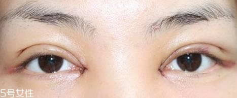 怎么縮短開(kāi)眼角疤痕消失時(shí)間？雙眼皮開(kāi)眼角恢復(fù)過(guò)程