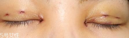 怎么縮短開(kāi)眼角疤痕消失時(shí)間？雙眼皮開(kāi)眼角恢復(fù)過(guò)程
