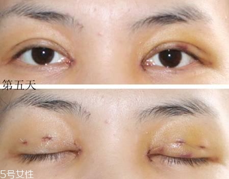 怎么縮短開(kāi)眼角疤痕消失時(shí)間？雙眼皮開(kāi)眼角恢復(fù)過(guò)程