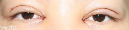 怎么縮短開(kāi)眼角疤痕消失時(shí)間？雙眼皮開(kāi)眼角恢復(fù)過(guò)程
