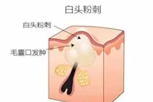 閉口是怎么引起的？4種情況要注意