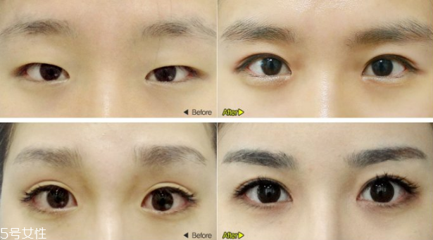 切開雙眼皮效果好嗎？韓式雙眼皮和歐式雙眼皮區(qū)別