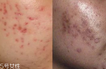 祛痘產(chǎn)品怎么選？先要分清痘印類型