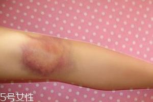 身體淤青怎么來的？不是磕碰那么簡(jiǎn)單