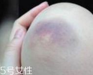 身體淤青怎么來的？不是磕碰那么簡(jiǎn)單