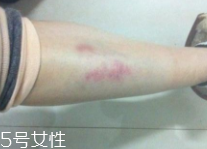 身體淤青怎么來的？不是磕碰那么簡(jiǎn)單