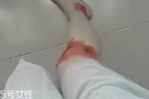 摔傷了涂什么藥好的快？做好消毒才能愈合快