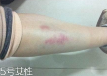 摔傷了涂什么藥好的快？做好消毒才能愈合快