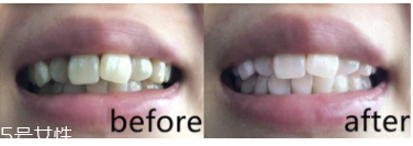 美白牙膏有用嗎？中華魔麗迅白牙膏評(píng)測