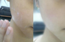 去角質(zhì)凝露哪些人不能用？痘痘肌別用