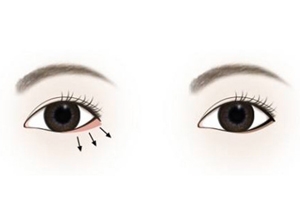 下眼瞼整形手術(shù)會(huì)留疤嗎？一般無(wú)明顯疤痕