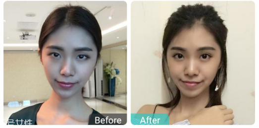 下瞼整形多久能恢復(fù)自然？半年時(shí)間