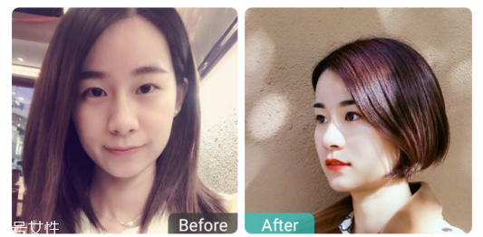 下瞼整形多久能恢復(fù)自然？半年時(shí)間