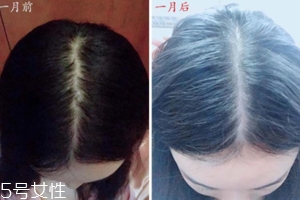 柳屋生發(fā)水有用嗎？一個(gè)月后長(zhǎng)出新發(fā)