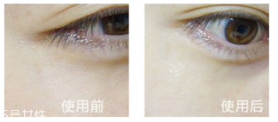 shangpree香蒲麗眼膜適合多大年齡？任何年齡