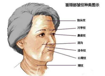 川字紋可以打玻尿酸嗎？不是最佳選擇